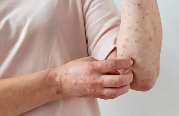 Confirmados 13 casos de sarampión en Morelos por Secretaría de Salud