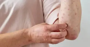 Aguascalientes reporta primer caso de sarampi&oacute;n en 2026