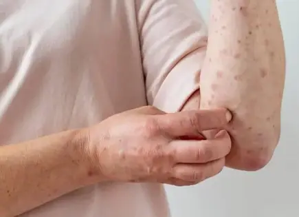 Confirmados 13 casos de sarampión en Morelos por Secretaría de Salud