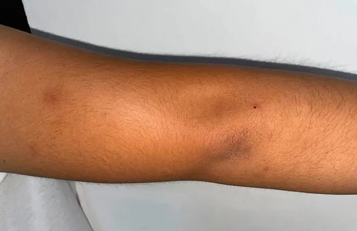 Alumnos de UASLP sufren picaduras de tábanos o jejenes