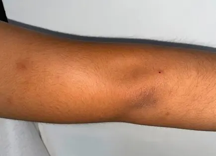 Alumnos de UASLP sufren picaduras de tábanos o jejenes