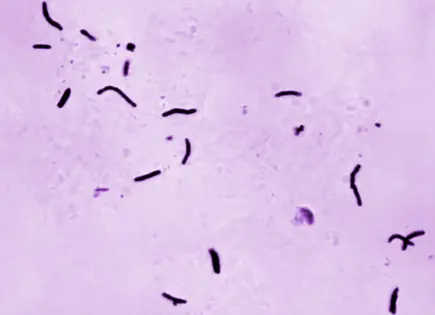 Aumento de casos de tuberculosis en EU preocupa a expertos