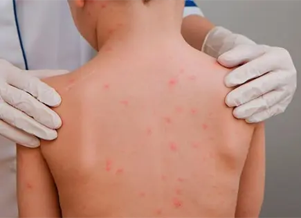 Aumentan los casos de sarampi&oacute;n en Jalisco