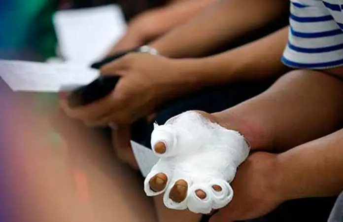 Hombre amputado por uso de pirotecnia