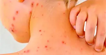 Aumentan casos de sarampi&oacute;n en 2025, dice Salud