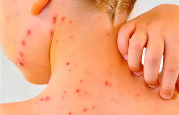 Aumentan casos de sarampi&oacute;n en 2025, dice Salud