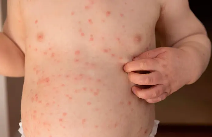 Casos de sarampión encienden las alertas