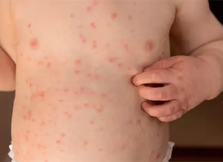 Fallece bebé por complicaciones asociadas al sarampión en Tlaxcala Fallece bebé por complicaciones asociadas al sarampión en Tlaxcala