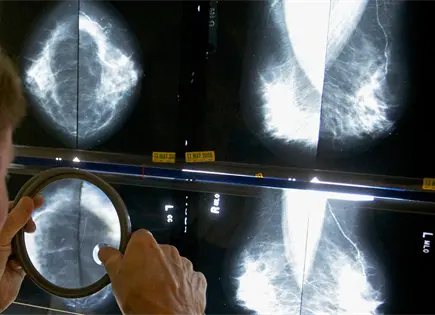 Investigaci&oacute;n revela impacto negativo de COVID-19 en pacientes oncol&oacute;gicos