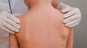 Aumentan a 33 los casos de sarampi&oacute;n en Tabasco