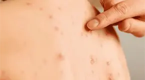 Jalisco registra mayor número de contagios de sarampión en 2026