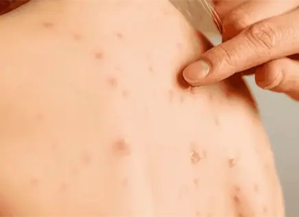 Alerta en Hidalgo por brote de sarampi&oacute;n