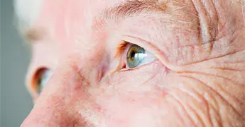 &iquest;Por qu&eacute; el calor aumenta el riesgo de cataratas?
