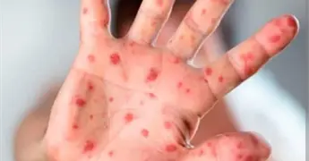 Sarampi&oacute;n suma 31 muertos en M&eacute;xico