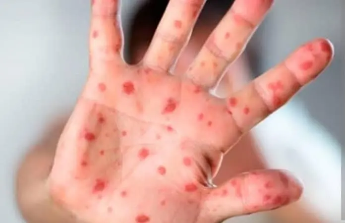 Confirman 3 casos de sarampi&oacute;n en SLP