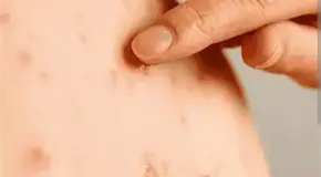 Niegan m&aacute;s casos de sarampi&oacute;n