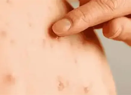 Vacunaci&oacute;n contra sarampi&oacute;n avanza con 18 millones de dosis aplicadas