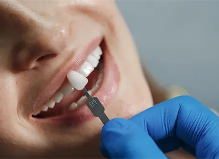 Todo sobre lo que debes saber sobre las coronas dentales