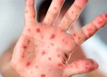 Sarampi&oacute;n en M&eacute;xico: aumento de casos y muertes en 2026