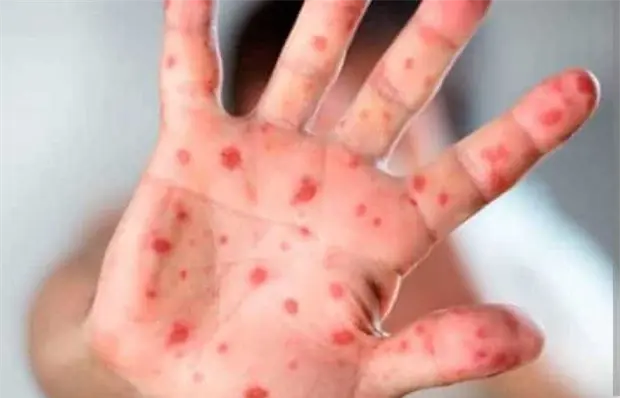 Crece  incidencia de sarampi&oacute;n