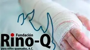 Requieren donativos para dar atenci&oacute;n a ni&ntilde;os quemados