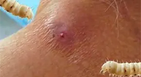 Reportan 4 casos de miasis por mes en humanos