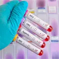 Aumentan casos  de s&iacute;filis y VIH